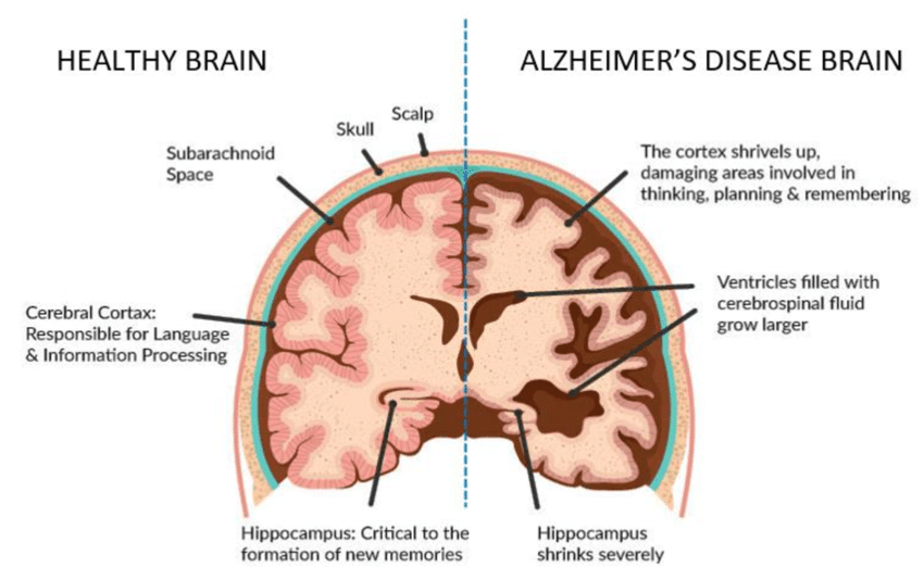 Differences in brain structure indicate risk for developing Alzheimer’s disease